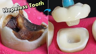 IMPOSSIBLE Restoration Of Tooth Caries  Amazing Before And After [upl. by Nylaroc281]