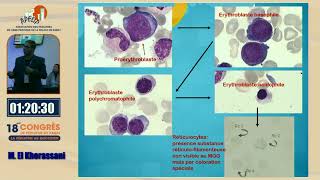 Atelier  Lecture de lhémogramme et la place du frottis sanguin M Khorassani [upl. by Gare]