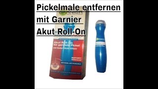 ▶︎ Akne Pickel Narben entfernen wegbekommen loswerden  Garnier Hautklar gegen Pickel [upl. by Ikoek998]