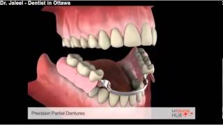 Prosthodontics  Precision Partial Denture  Ottawa Dentist [upl. by Ful234]