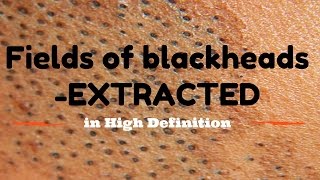 Blackhead fields extractions in HD [upl. by Aneekas694]