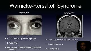 Wernickes Korsakoff syndrome [upl. by Niels855]