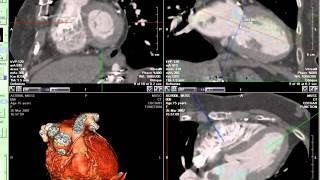 Coronary CT Angiography Mass [upl. by Ttreve]