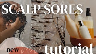 The EASIEST way to get rid of scalp sores [upl. by Erialb]