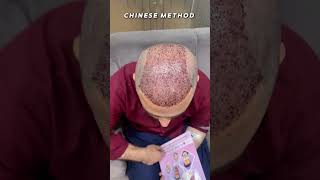 Chinese Method 8000 Grafts before amp after result of hair transplant 😎👍 [upl. by Siuqramed675]