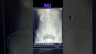 Intra venous urogram  pyelogram  radiological xray medicalimaging doctor anatomy [upl. by Stiruc260]