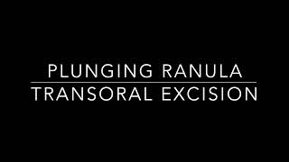 Plunging ranula surgery [upl. by Malloy]