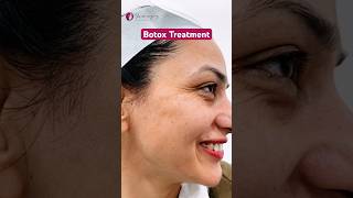 Wrinkles around the eyes  Botox Treatment for Face  Best Skin Clinic in Noida [upl. by Raouf311]