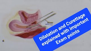 Dilatation and Curettage  D and C in HINDI made Easy [upl. by Airrej]