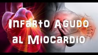 Infarto agudo al miocardio [upl. by Ane]