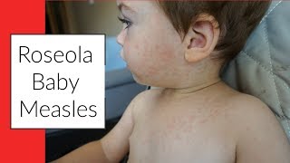 ROSEOLA  BABY MEASLES  SIGNS amp SYMPTOMS  RASH [upl. by Rehm]