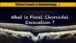 What is Focal Choroidal excavation  FCE [upl. by Vincelette244]