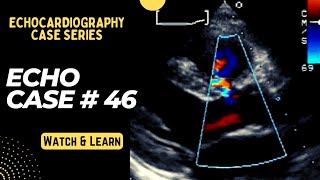 Echo Case 46 Echocardiography Spot Diagnosis Series  Cardiology [upl. by Hut]