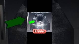 Cystitis  Foley Catheter in situ  Thick walled U Bladder on Ultrasound [upl. by Nerol454]