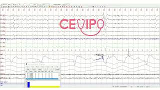 Etapa N2 a N3  Polisomnografía [upl. by Sirroned109]