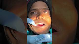 Tmj dislocation dentist [upl. by Nawud]