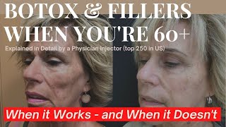 Botox amp Filler Over 60 When It Works amp When It Just Doesnt Cut It Anymore [upl. by Anitnemelc]