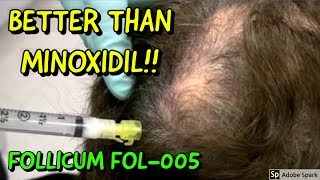 Follicums FOL005 is BETTER than MINOXIDIL [upl. by Ettennod]