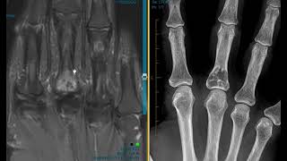 Lytic lesion finger on xray [upl. by Jepson]