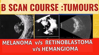 Bscan course  Differentiating choroidal melanoma from retinoblastoma and choroidal hemangioma [upl. by Ivets]