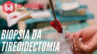 Resultado da biópsia da tireoidectomia  Como interpretar  Dr Jônatas Catunda [upl. by Naesar]