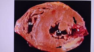 Left ventricular pseudoaneurysm  impending rupture  CT angiogram findings [upl. by Ahsakal497]