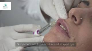 How to do Lip Fillers  Flora Clinic Istanbul 2019 [upl. by Aoket]