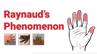 Raynaud’s Phenomenon  What You Should Know  Johns Hopkins Medicine [upl. by Conners]