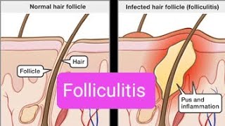 Folliculitis Definition of folliculitis Causes of folliculitis Symptoms of folliculitis✨ [upl. by Yorel]