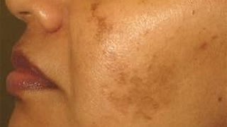 5 Home Remedy for Pigmentation Hyperpigmentation Brown Spots Discoloration NaghmaSyed [upl. by Aihsyt]