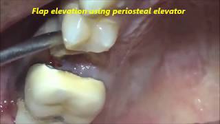 Grossly decayed Upper Pre Molar Extraction [upl. by Liag]