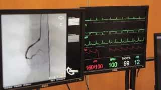 Cardiac Catheterisation Part 2  Right Coronary [upl. by Schifra733]