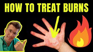 HOW TO TREAT AND MANAGE BURNS AND SCALDS  DOCTOR EXPLAINS plus first aid tips [upl. by Teirrah]