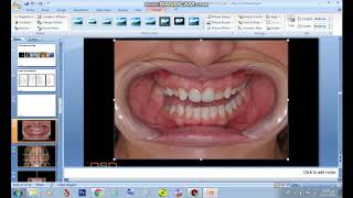 تصميم الإبتسامة الرقمية خطوة بخطوة  Step by Step Creat your DSD  Digital Smile Design  tutorial [upl. by Westfahl]