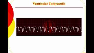 Ventricular arrhythmias [upl. by Brouwer398]