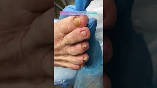 РЕЗУЛЬТАТ ЗАЧИСТКИ НОГТЯ КАК ВАМ RESULT OF NAIL CLEANING HOW DO YOU DO nails shortsvideo [upl. by Soinotna]