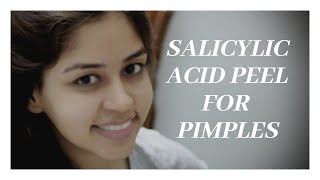 Salicylic Acid Peel For Pimplesdranvikacom [upl. by Nallak]