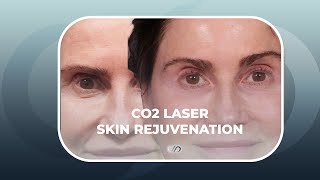 CO2 Laser Resurfacing Around the Eyes  Los Angeles [upl. by Paulie828]