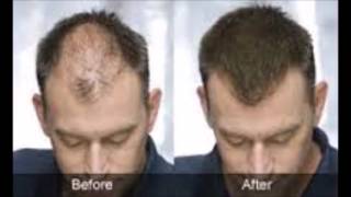 Seborrheic Dermatitis Hair Loss Before And After Seborrheic Dermatitis Hair Loss Before And After [upl. by Guildroy]