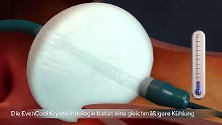 Medtronic  Katheterablation mit dem Kryoballon  Vorhofflimmern [upl. by Id]