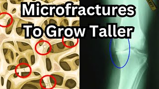 How To Grow Taller After Puberty Full Microfracture Guide with reallife examples [upl. by Ramburt]