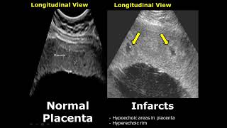 Placenta Ultrasound Normal Vs Abnormal Image Appearances Comparison  Placental Pathologies on USG [upl. by Ramej]