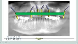 Season 1 Ep 3  Mastering Pterygoid implants and digital planning A comprehensive exploration [upl. by Leuqer]