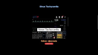 Sinus Tachycardia  what to do  Cardioversion [upl. by Acinyt]