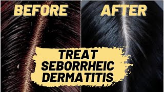 How to Treat Seborrheic Dermatitis Natural Hair Treatment  Repair Your Scalp amp Hair Loss [upl. by Muffin]