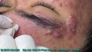 Big Cystic Acne Blackheads Extraction Blackheads amp Milia Whiteheads Removal Pimple Popping [upl. by Niwre336]