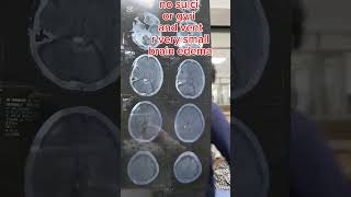 Cerebral atrophy vs cerebral edema [upl. by Sirac]