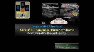 Ultrasound Case 243  Parsonage Turner Syndrome [upl. by Ahsinor226]