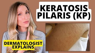 Dermatologist Explains Keratosis Pilaris KP Affordable Drugstore Treatments to Try [upl. by Reena200]