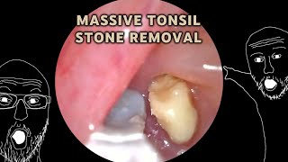 Multitude of Massive Tonsil stones removed  AIM 20 [upl. by Mallis909]